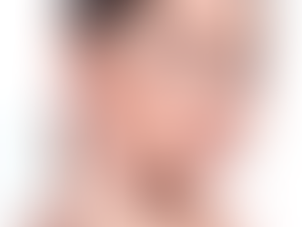 Humpy Nose Surgery