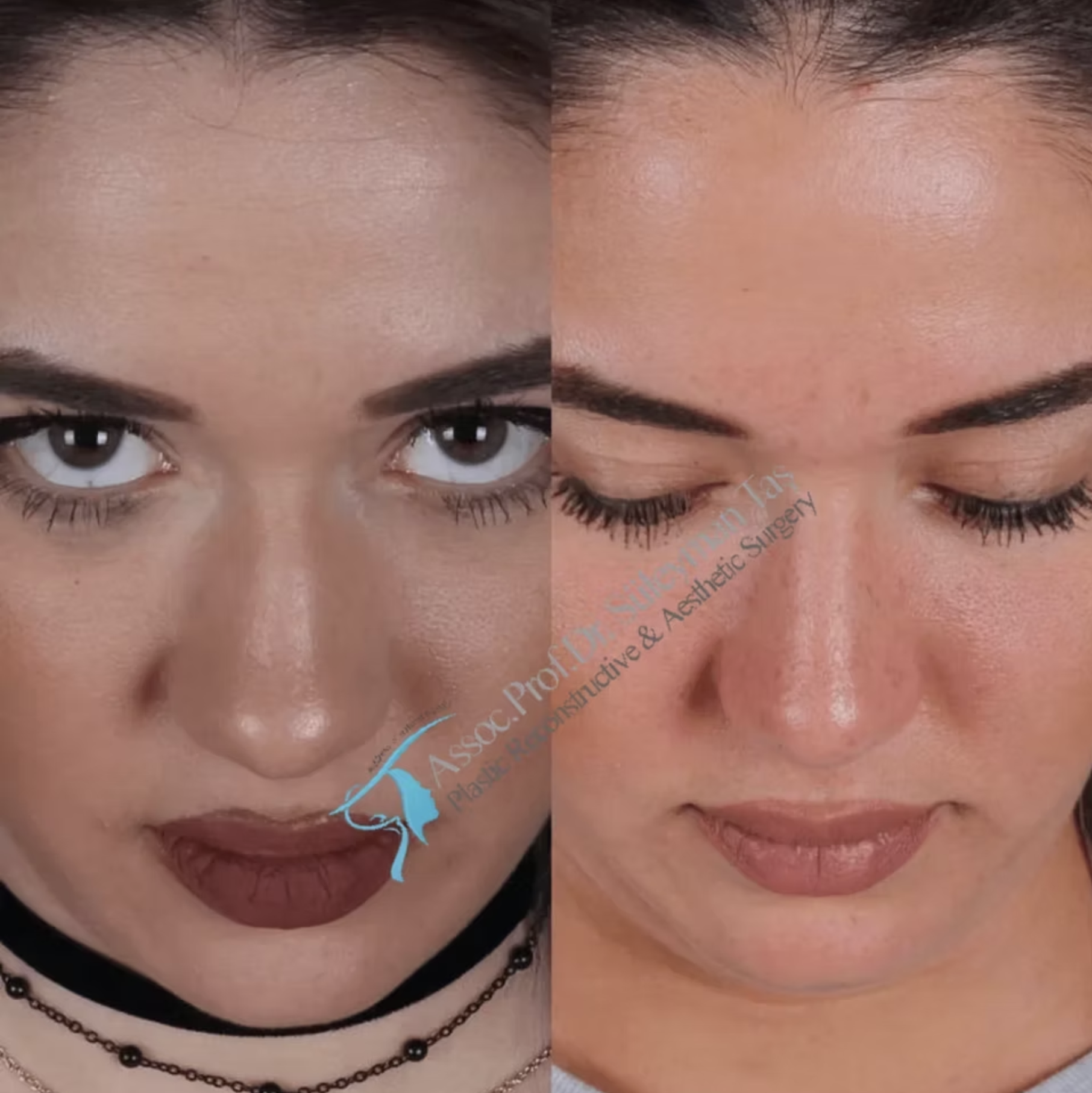 Suleyman Tas Male Rhinoplasty Before After