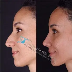 Suleyman Tas rhinoplasty healing process