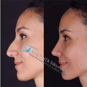Suleyman Tas rhinoplasty healing process