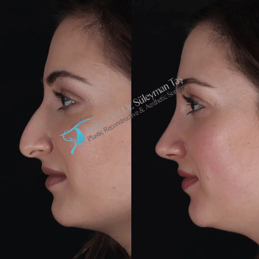Suleyman Tas Before After Rhinoplasty