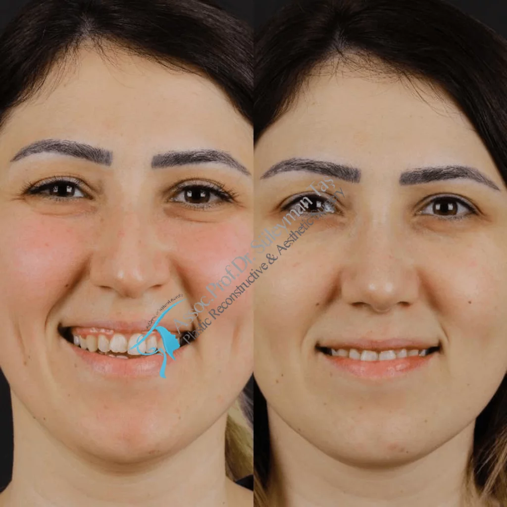 Suleyman Tas Before After Rhinoplasty