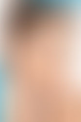 Skin Thickness for Rhinoplasty