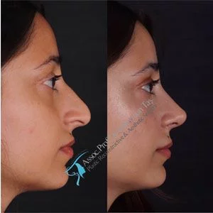 Suleyman Tas Before After Rhinoplasty