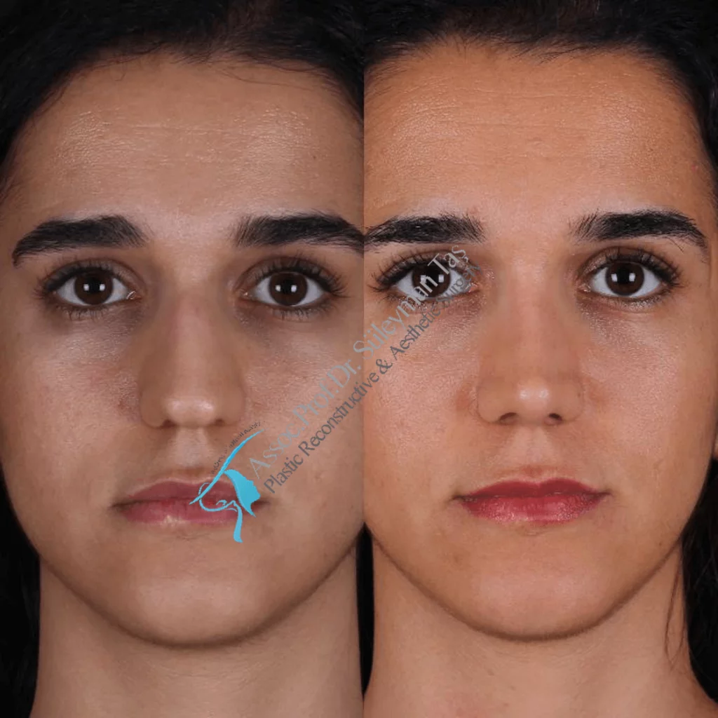 Suleyman Tas Before After Rhinoplasty