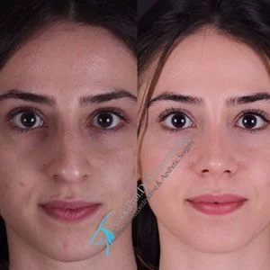 Suleyman Tas Before After Rhinoplasty