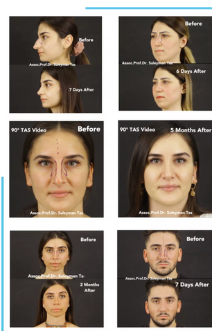 Dr Suleyman Tas Rhinoplasty Before After