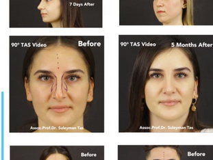 90° TAS® Video | Rhinoplasty Before and After Videos