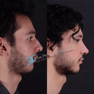 Dr Suleyman Tas Male Rhinoplasty Recovery Results