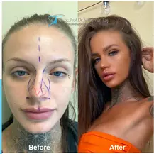 How long does it take to recover from a rhinoplasty?