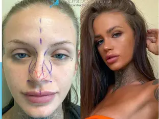 How long does it take to recover from a rhinoplasty?