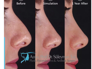 Simulation In Rhinoplasty