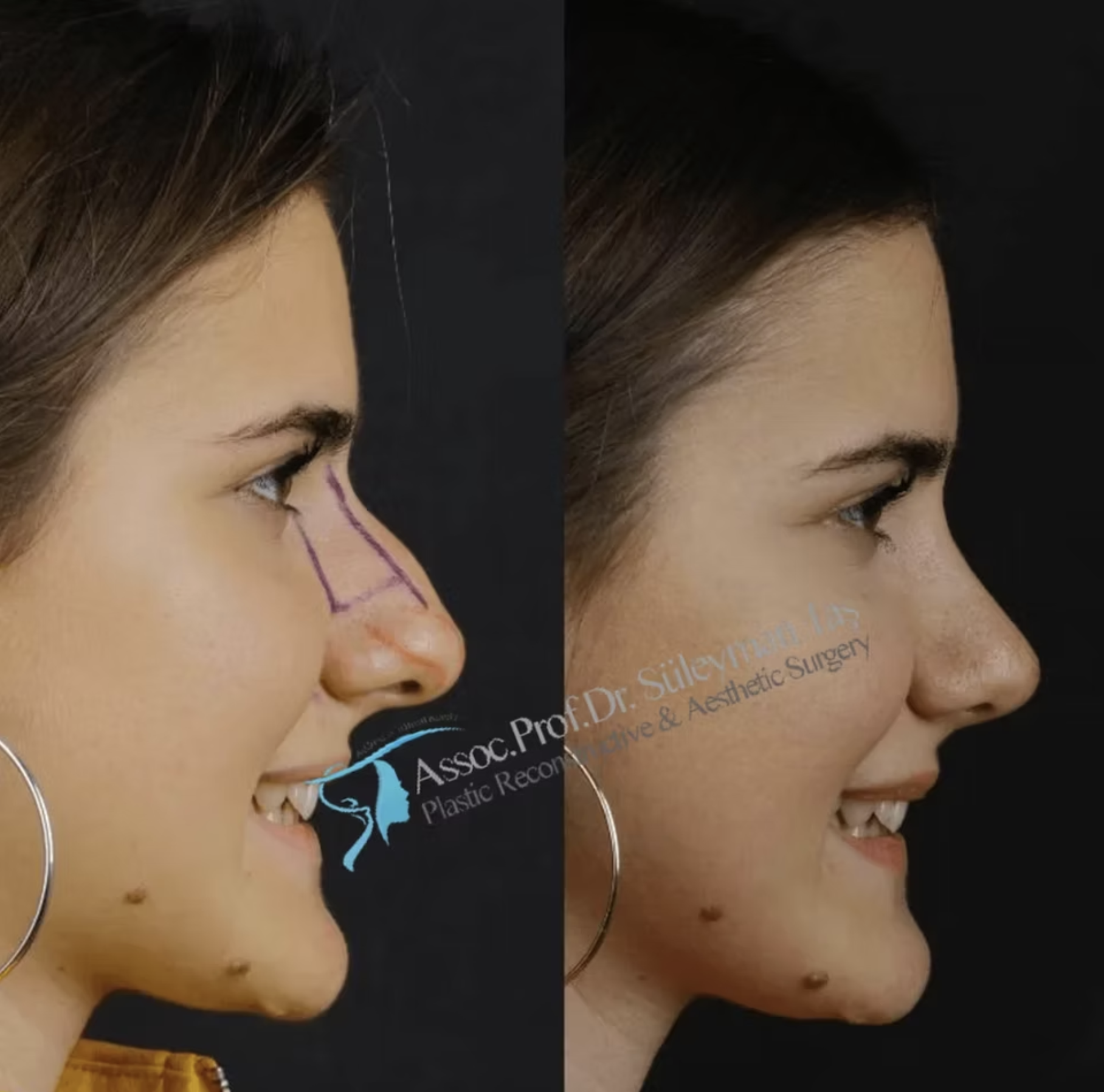 Suleyman Tas Closed Rhinoplasty Results