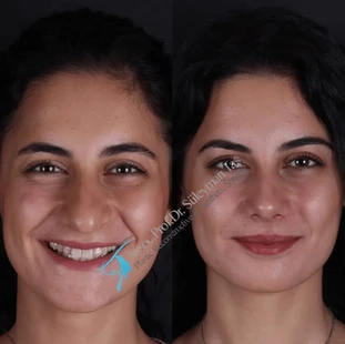 Suleyman Tas rhinoplasty transformation