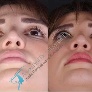 Revision Rhinoplasty Before After Istanbul