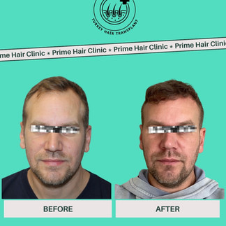 Turkey Hair Transplant