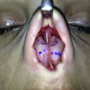 Modification of the Lateral Crural Suspension Flap — Prof. Dr. Suleyman TAS