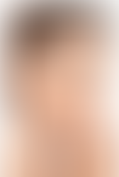 Skin Thickness for Rhinoplasty