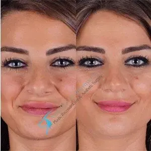 Suleyman Tas straight nose rhinoplasty