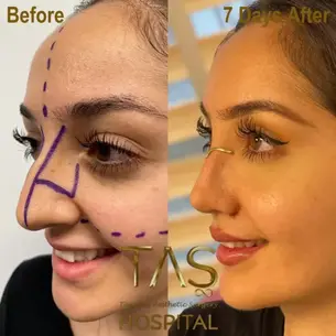 Case Study – Nose Surgery