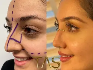 Case Study – Nose Surgery