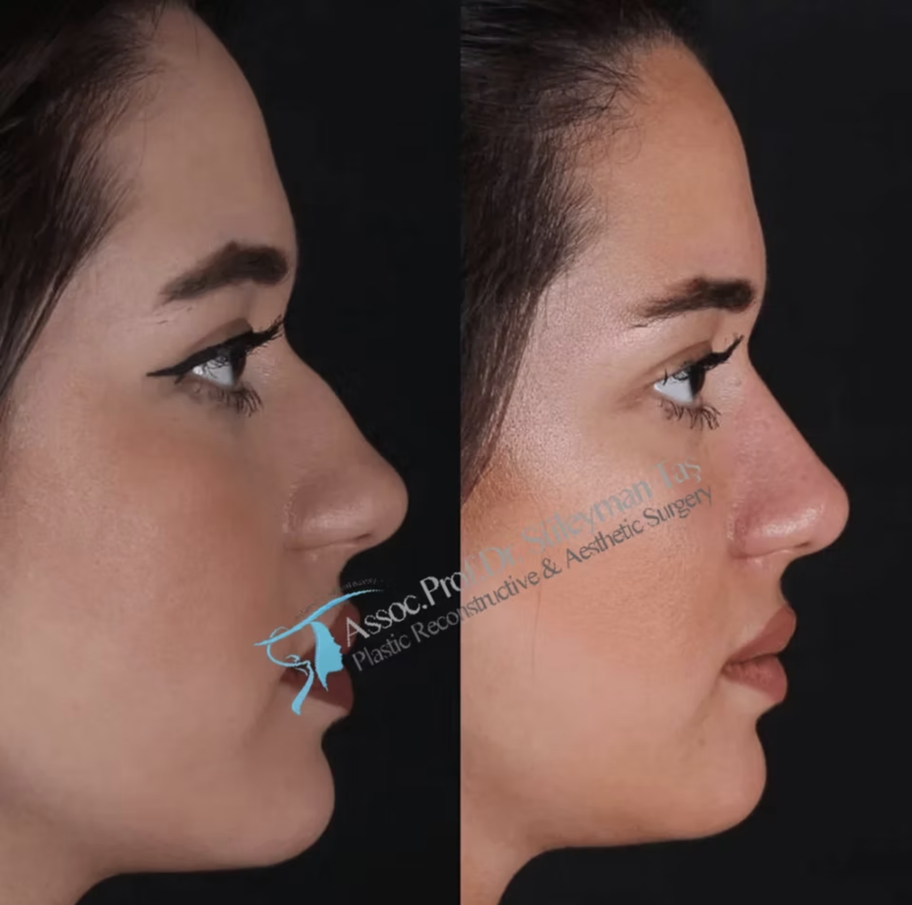 Suleyman Tas Revision Rhinoplasty Before After