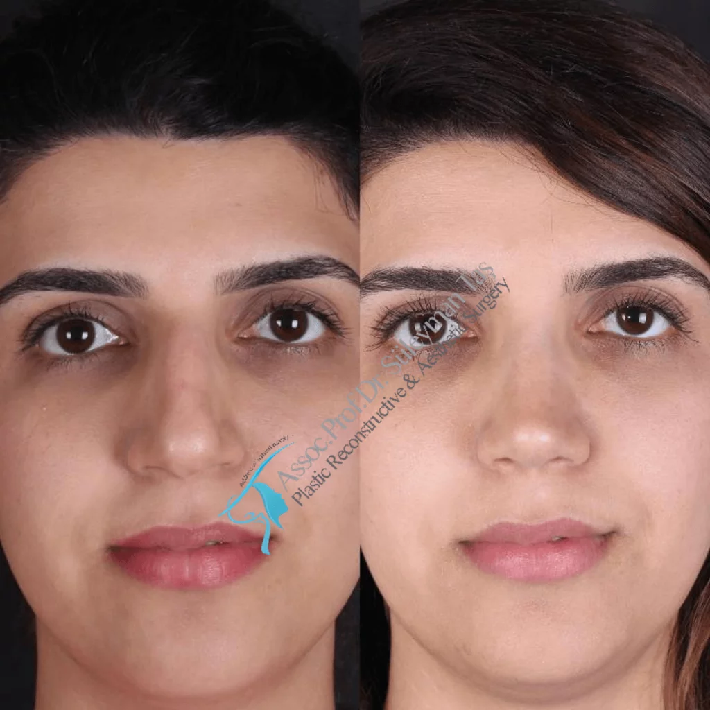 Suleyman Tas Before After Rhinoplasty