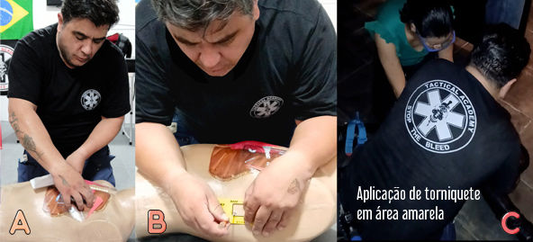 A. Aplicação de selo de tórax valvulado B. Aplicação de agulha de descompressão toracica C. Aplicação de torniquete em vítima baleada em treinamento tático CQB