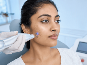 Picosecond laser for stubborn pigmentation - Amber Skin Clinics