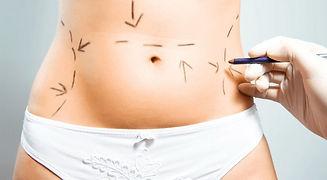 Abdominoplastía.jpg