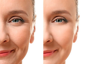 lifting-facial-y-de-cuello-1-e1549283211