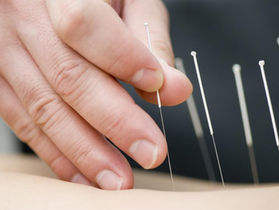 5 Amazing Health Benefits of Acupuncture