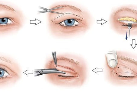 Yếu tố ảnh hưởng đến chi phí cắt mắt sụp mí