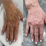 lumecca avant-apres taches de vieillesse