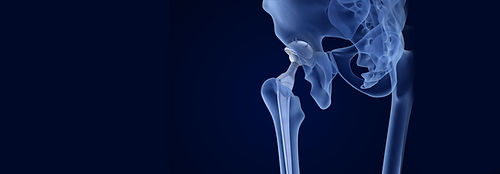Single-use Surgical Instruments - Cingular Orthopaedics