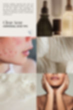 Tips for overcoming hormonal acne. Pinterest image.