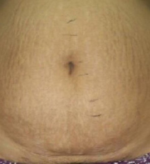 Stretch Mark After.jpeg