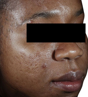 Acne Scar Before fitz 5.jpeg