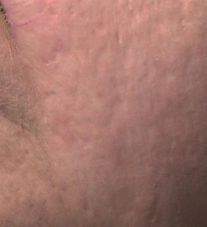 Acne Male Scarring after.jpeg