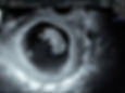 2D Ultrasound