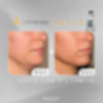 拉提王者|Ulthera超聲刀的真正實力:分層抗老原理、效果及優勢