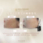 Hollywood Spectra® 雙光震科技 全球NO.1 嫩膚去斑 技術