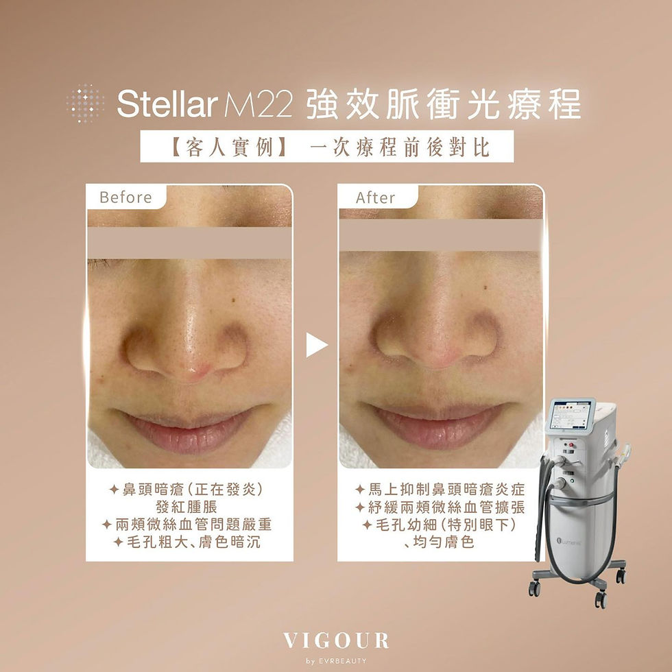 Lumenis Stellar M22醫療版超脈衝光子嫩膚