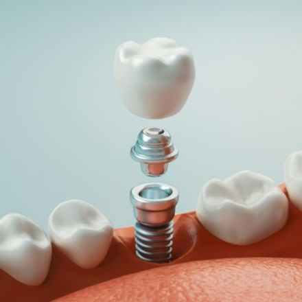 I need a tooth implant