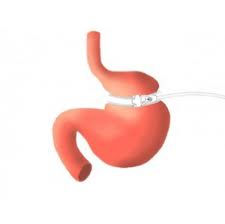 gastric band hypnosis
