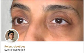 Polynucleotides for facial rejuvenation, available at Moreton Aesthetics.  