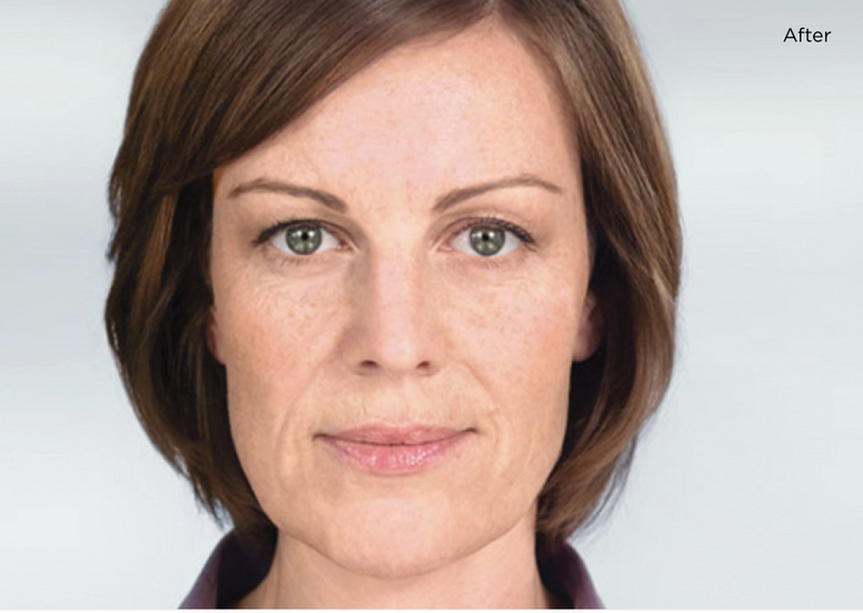 Sculptra® 24 months after treatment courtesy of Galderma USA