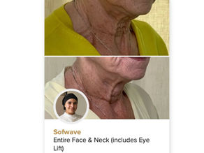 SOFWAVE™: CLINIC RESULTS WITH NO DOWNTIME; JUST LIFTED FIRMER SKIN.