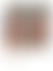 UNLOCKING THE SECRET TO YOUTHFUL SKIN: DISCOVER RADIESSE® AT MORETON AESTHETICS