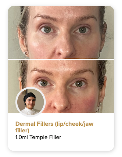 Temple filler can give an immediate softening effect.